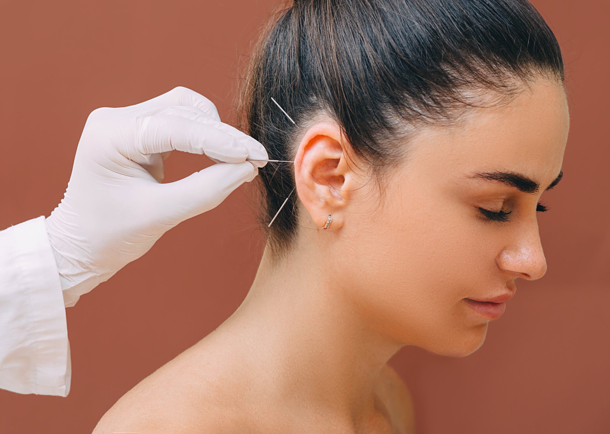 Auricular Acupuncture